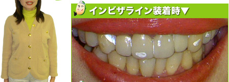インビザライン装着時